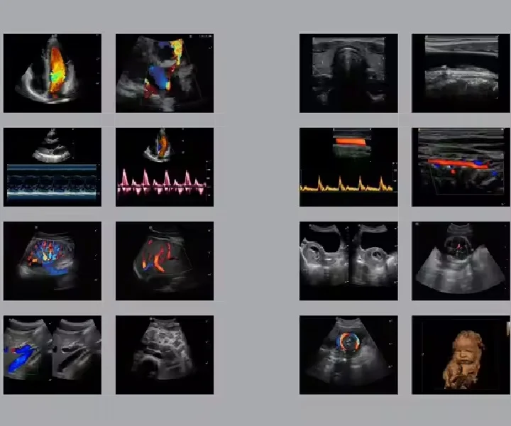 'SonoScape ultrasound'